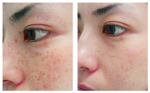 Laser Sun Damage Treatments for Hyperpigmentation | Windsor, Ontario