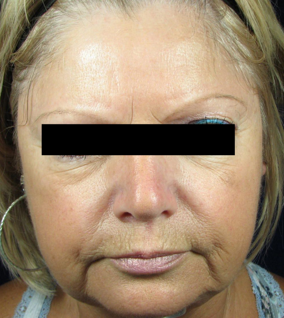 Fine Lines  DermaSweep