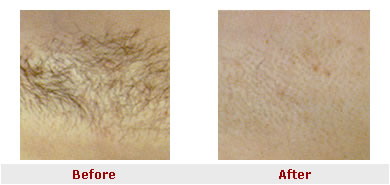 Is Shorter Hair or Longer Hair Better for IPL Hair Removal?