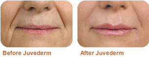 juvederm_bef_aft1