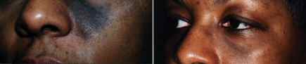 Laser Birthmark Removal Nevus of Ota Blue Facial Birthmark Picture 1