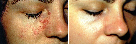Laser Birthmark Removal Port Wine Stain Picture 1