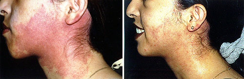 port wine birthmark removal