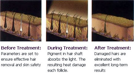 IPL Hair Removal - Coral Medical Health Spa