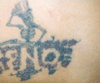 Tattoo Removal in Windsor Ontario Before Pic 3