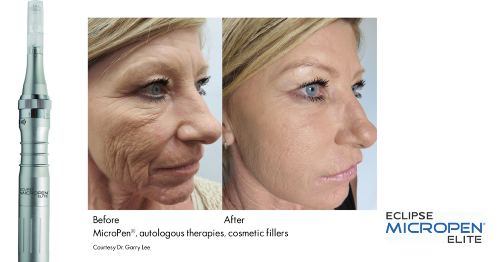 Microneedling Pic