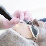 special laser carbon peel e